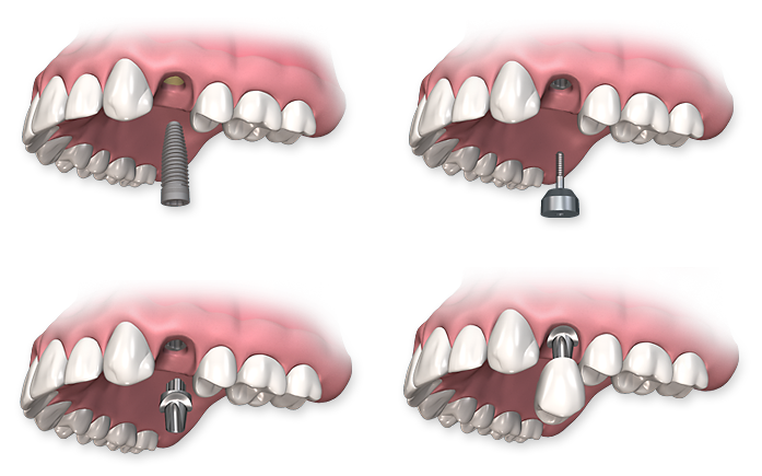 Implantes Dentários