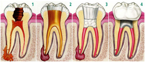 Endodontia / Desvitalização Dentária - Clínica Dentária do Marques - O seu  dentista em Lisboa